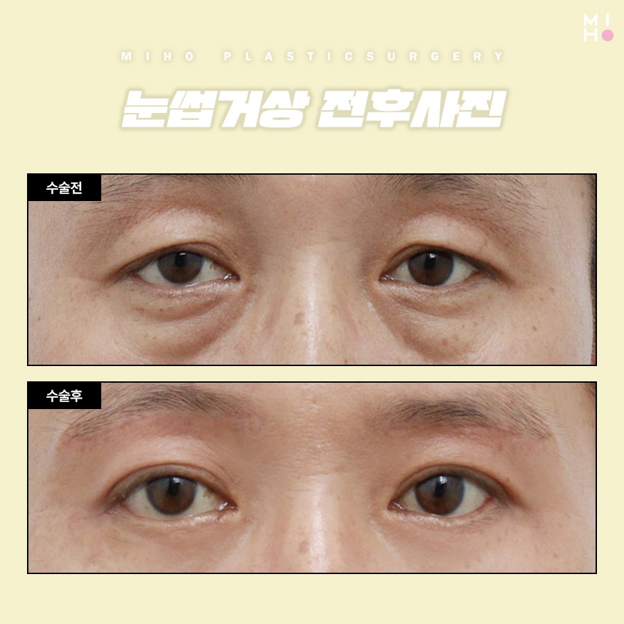 Brow Lift Review: You Could Be the Next Success Story image 7