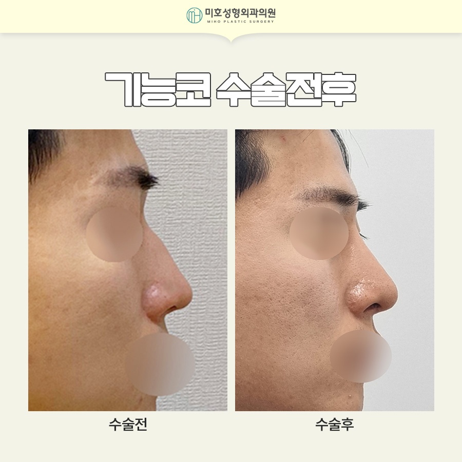 If You're Curious About Who Is Recommended for Nasal Valve Reconstruction and the Recovery Period image 10
