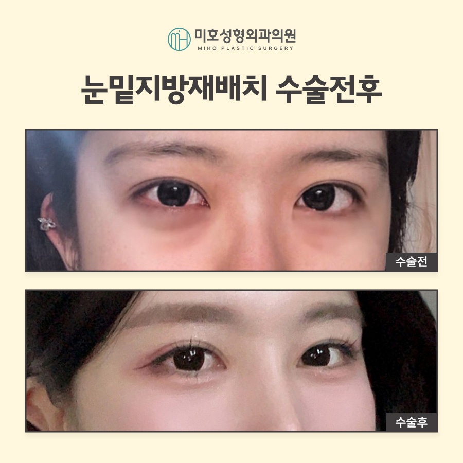 눈밑지방재배치 빠른 대처 방안 관련 이미지 9
