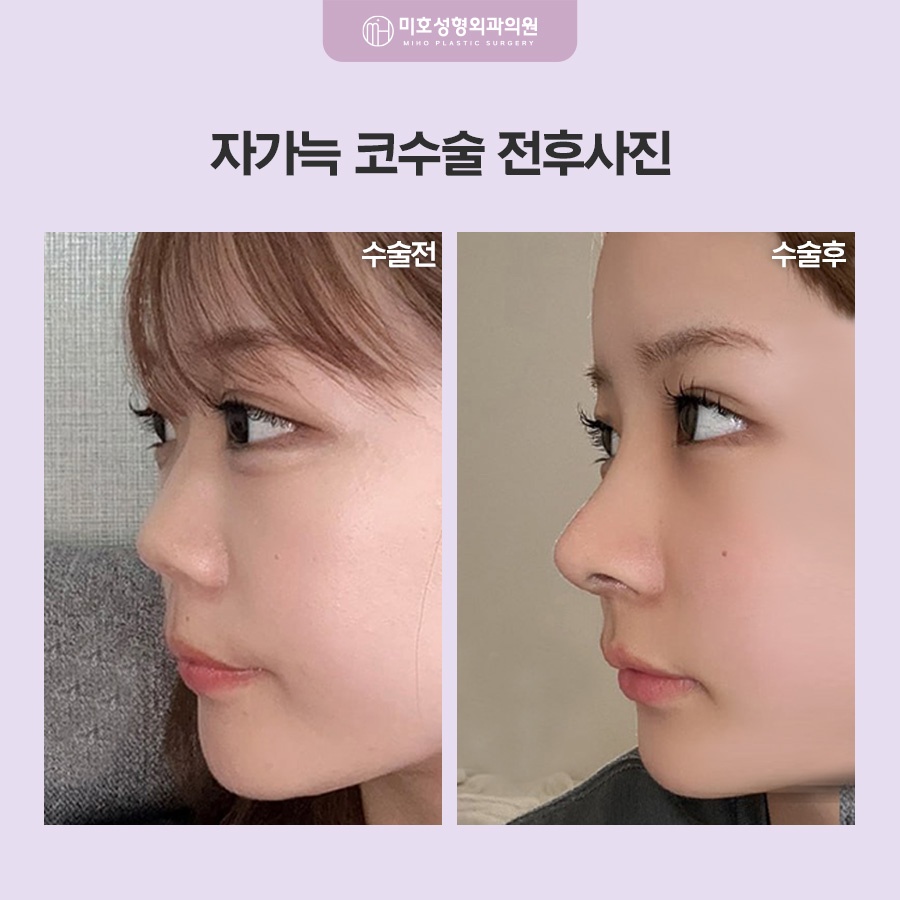 자가늑코수술 흉터와 통증이 걱정된다면 관련 이미지 10