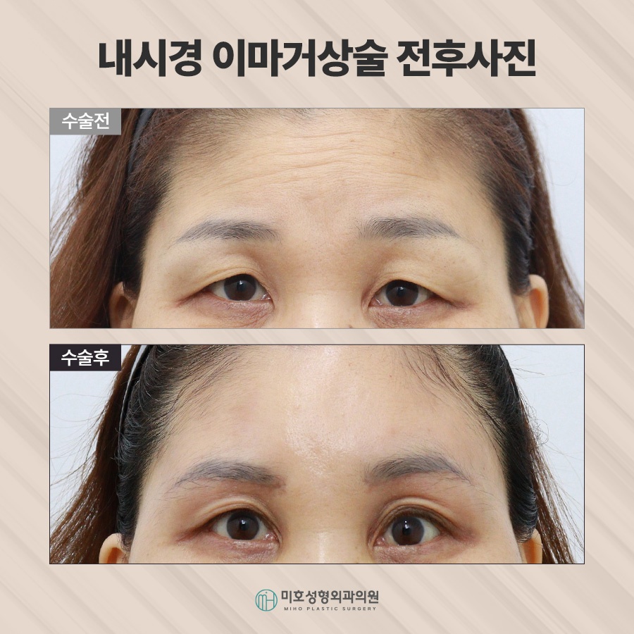 이마거상후기 진행과정 및 체크할 점 관련 이미지 9