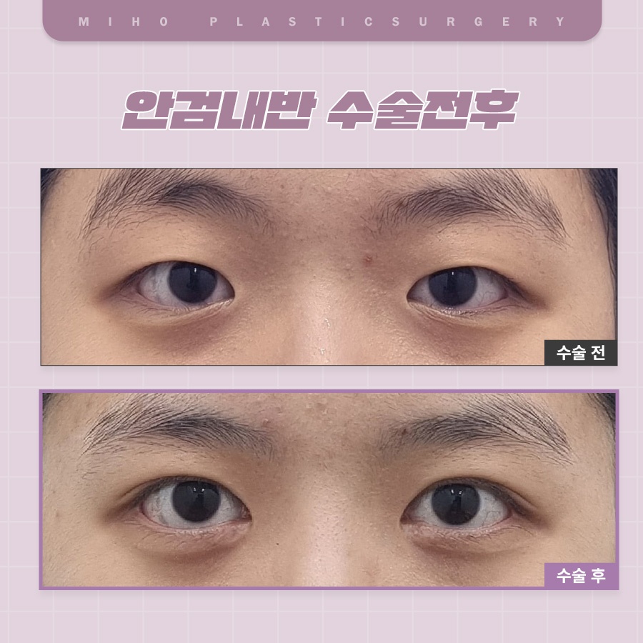안검내반 속눈썹찔림 원인과 관리 관련 이미지 5