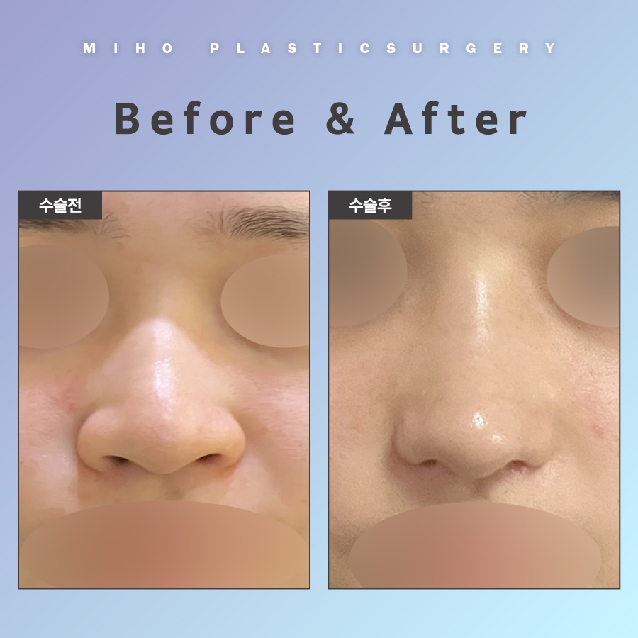 Natural-Looking Alar Reduction with Minimal Incisions image 9