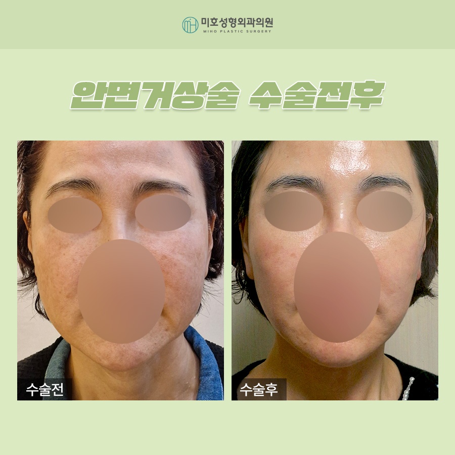 Wondering About the Side Effects of a Facelift? image 9