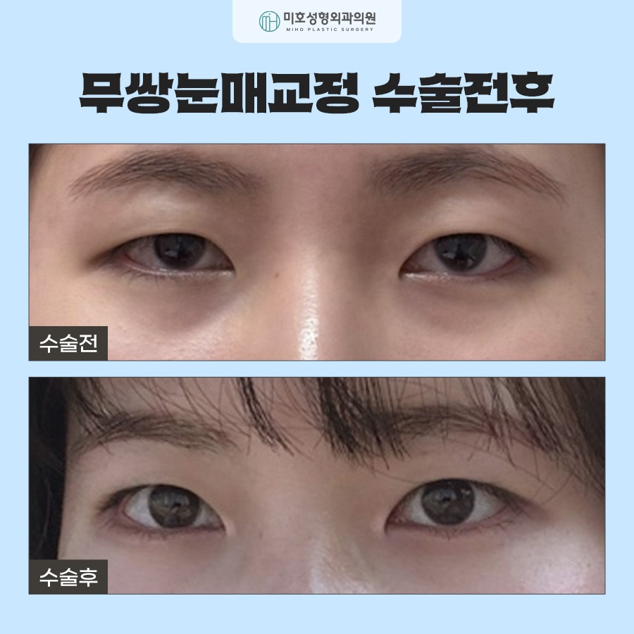 무쌍눈매교정 전후 차이를 비교해보고 관련 이미지 6
