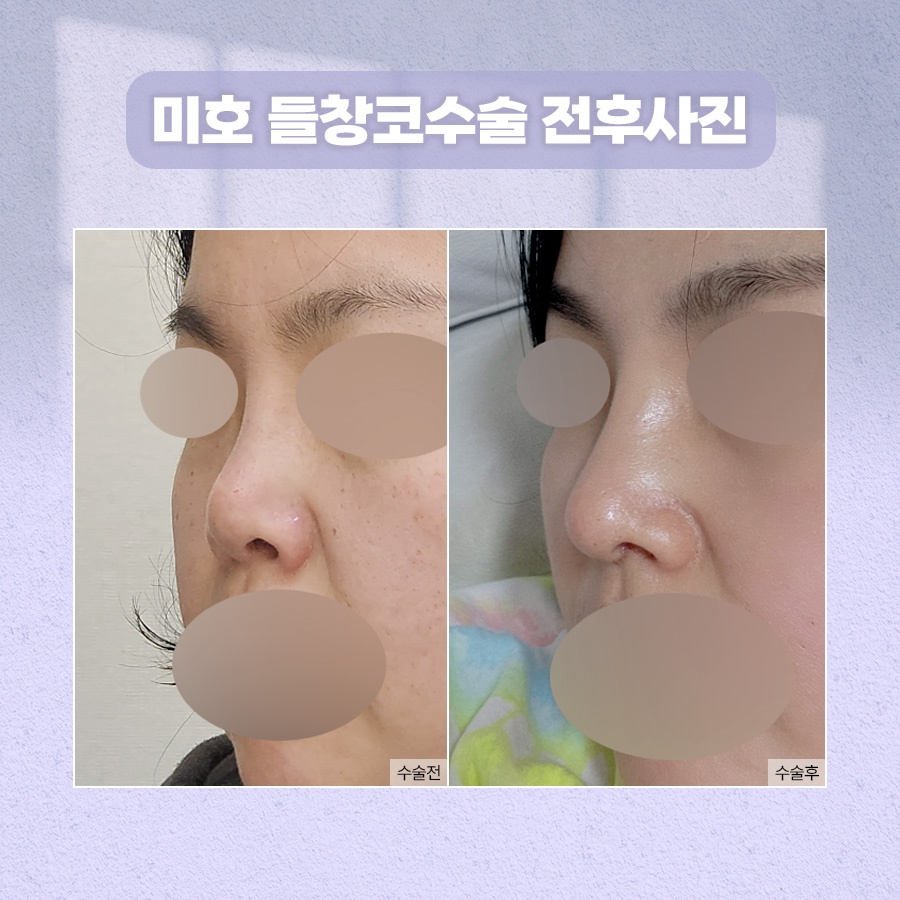 들창코수술 자연스러운 각도 기준 관련 이미지 8