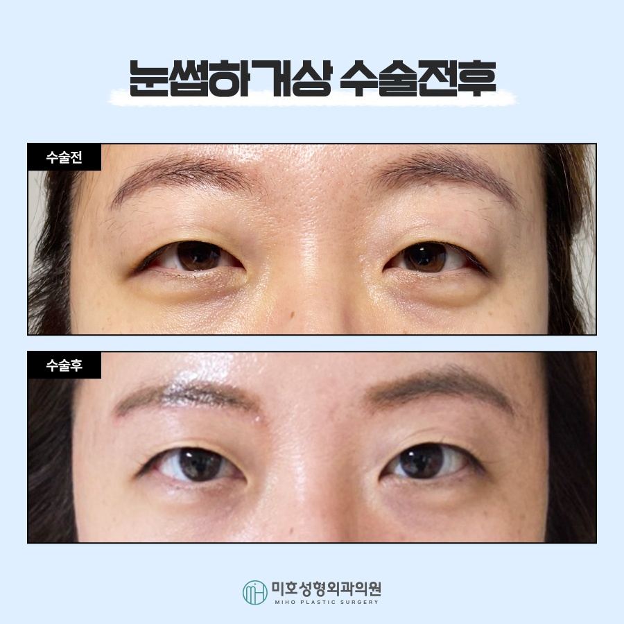 눈썹하거상 노안형 얼굴에 변화를 주려면 관련 이미지 7