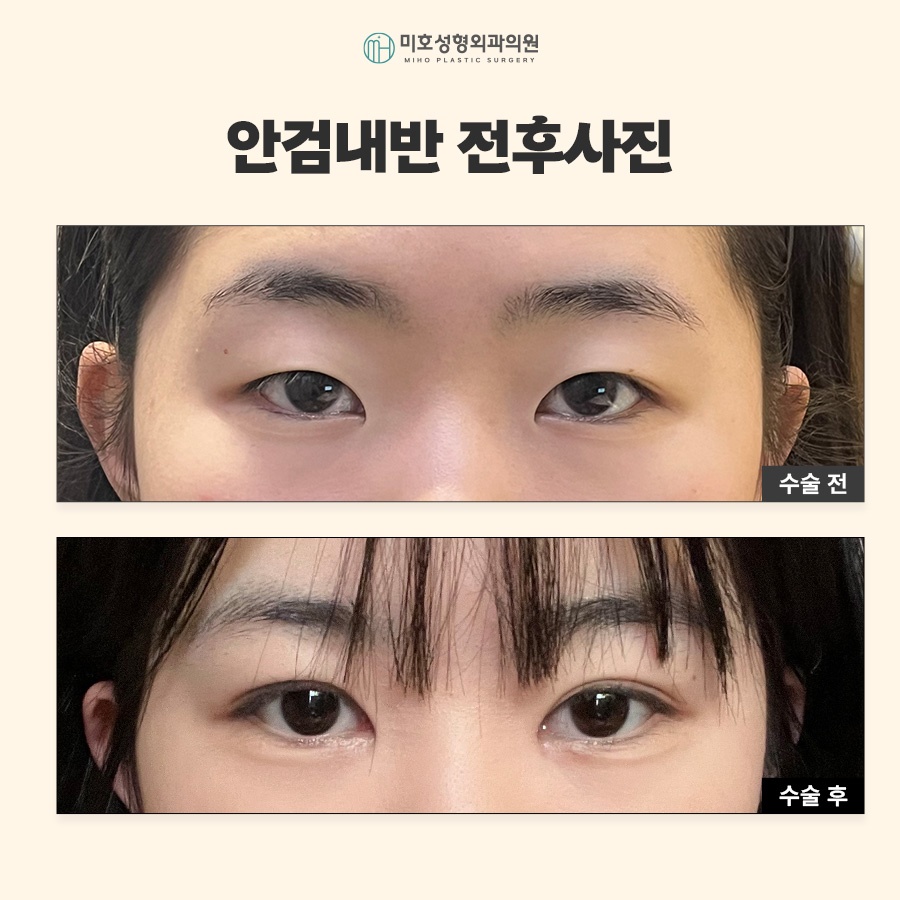 안검내반수술 눈물과 자극이 반복된다면 관련 이미지 8