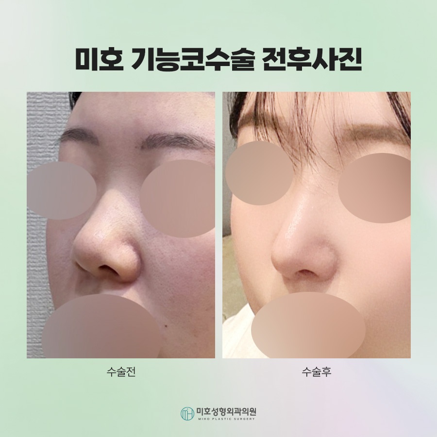 Who May Need Inferior Turbinate Reduction and How to Choose the Appropriate Method image 8