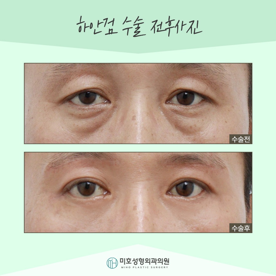 If Lower Blepharoplasty Is Needed for Drooping Eyes image 9