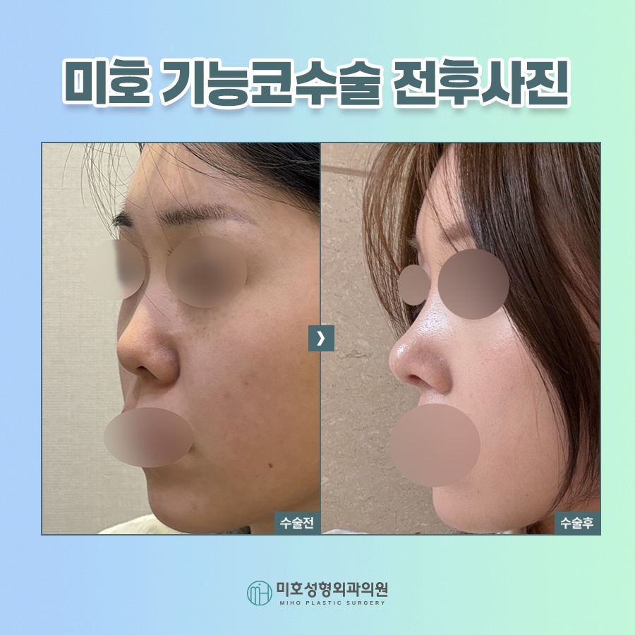 비밸브재건술 진행시 고려할 부분 관련 이미지 10