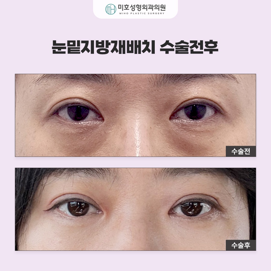 To Learn About Under-Eye Fat Graft Reviews, Methods, Swelling, and Recovery image 10