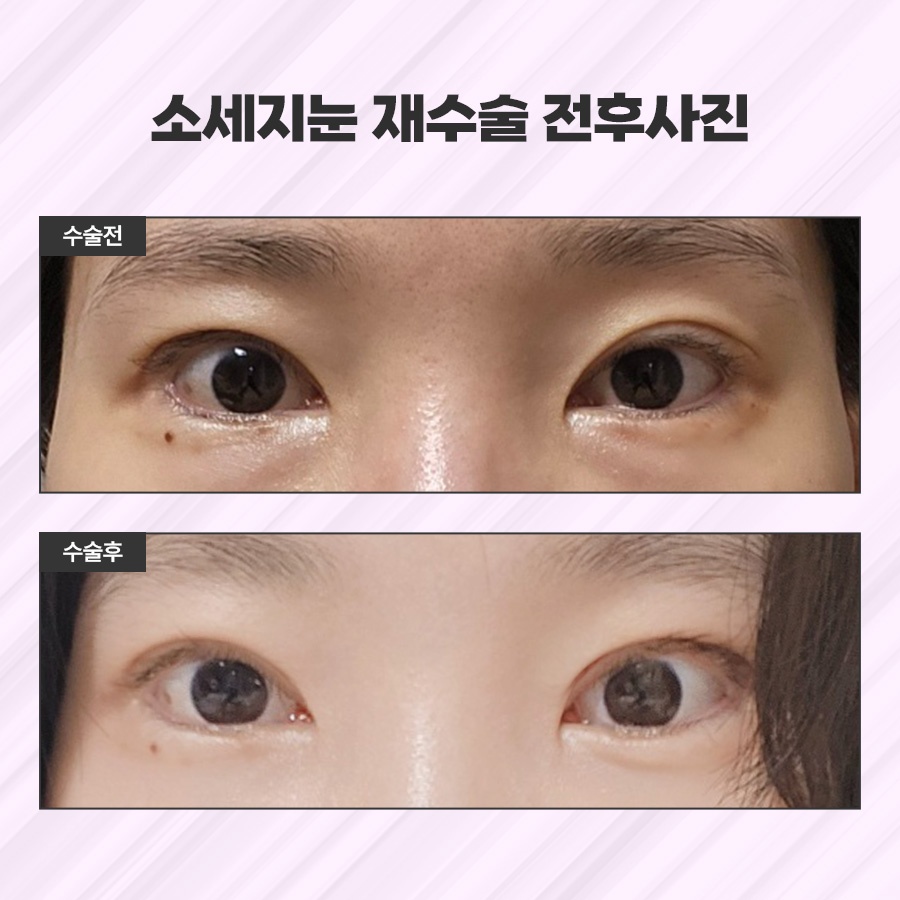 소세지눈재수술 적용 방식 2가지 관련 이미지 10