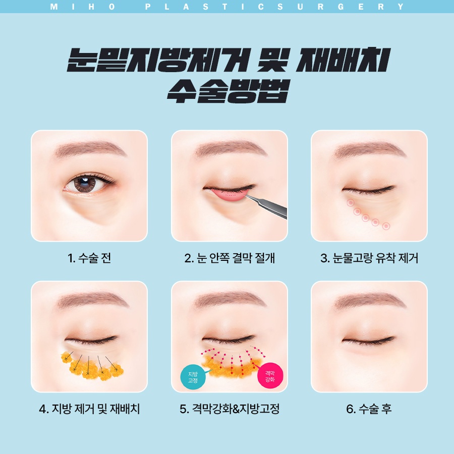 눈밑지방제거 하안검 다크써클 개선 방법 관련 이미지 5