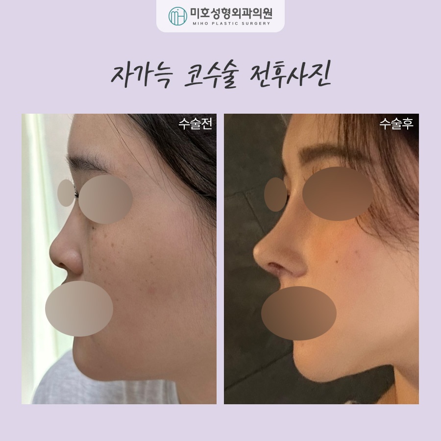 For a Natural-Looking Result with Costal Cartilage Nose Surgery image 8