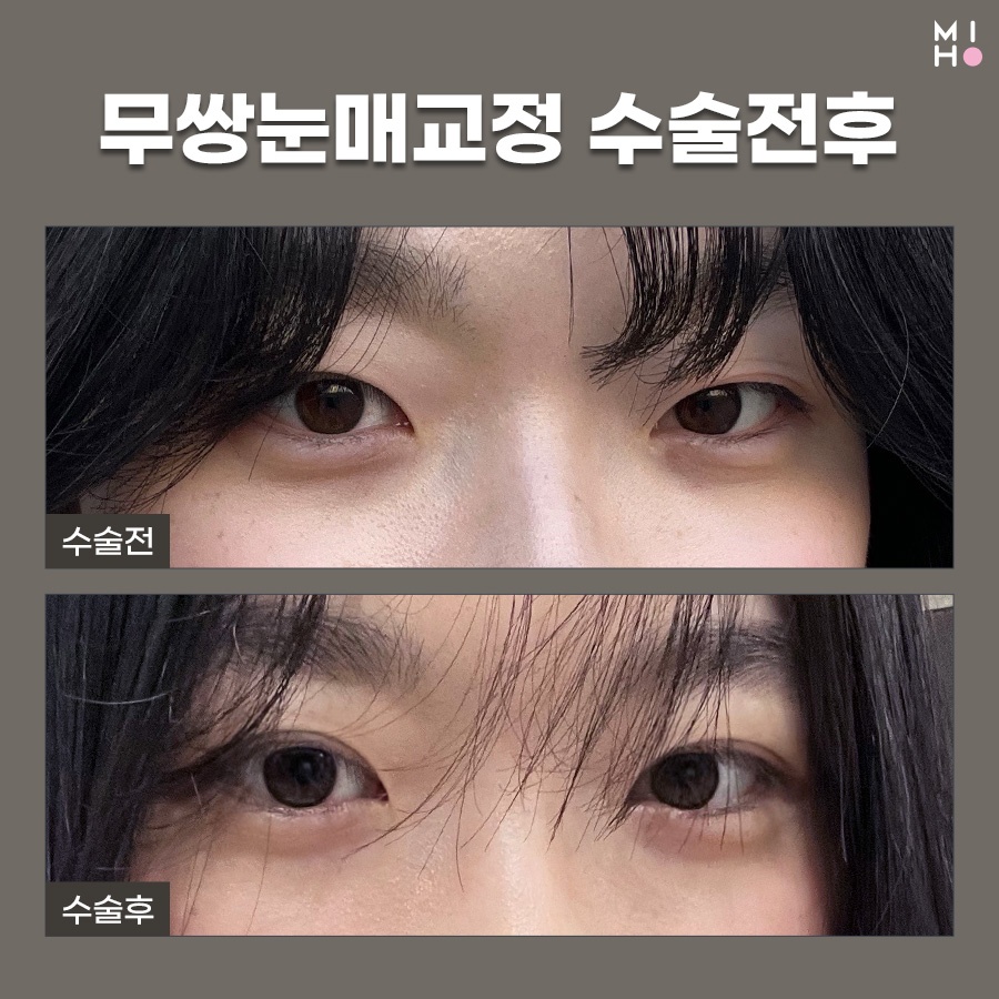 무쌍눈매교정 상황에 따른 개선법 관련 이미지 7