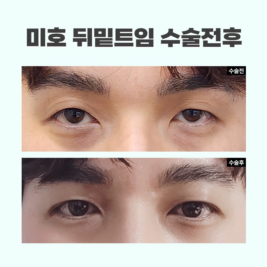 뒷트임밑트임후기 주의할 점 관련 이미지 8