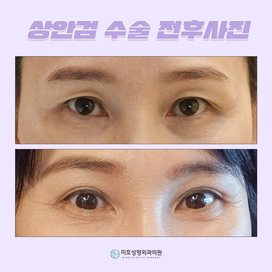 상안검수술 해당하는 유형은 관련 이미지 8