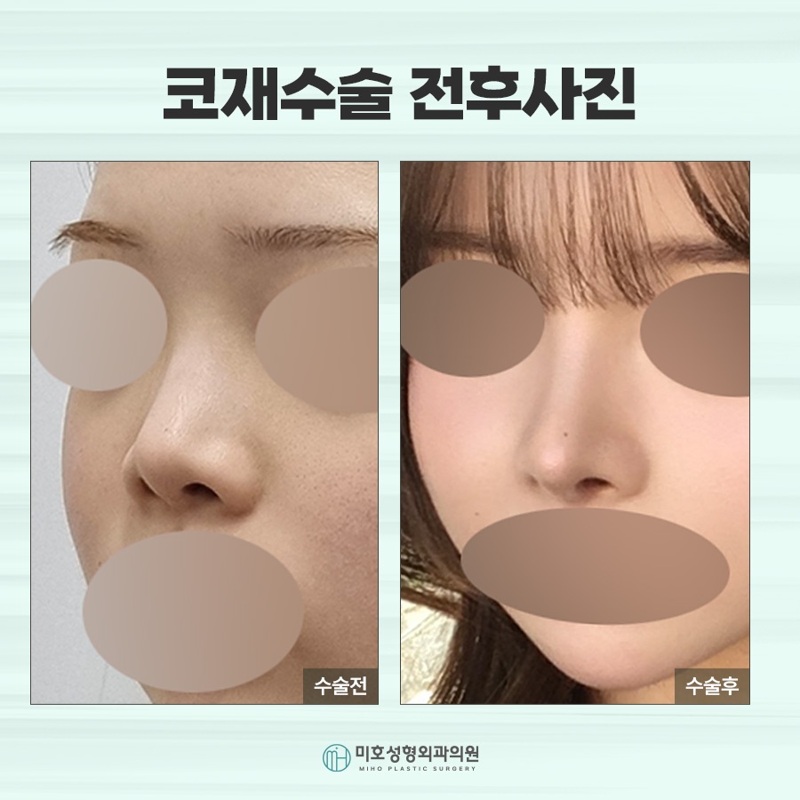 신논현코재수술 체크포인트 관련 이미지 9