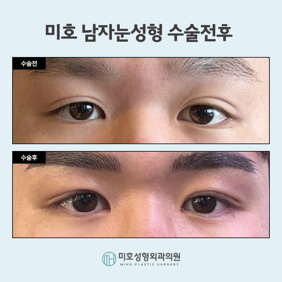 Focusing on a Natural Look in Male Eye Surgery image 9