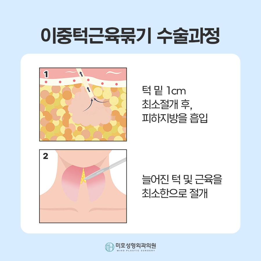 If the Jawline Beneath the Chin Looks Blurred: Double-Chin Muscle Tightening image 3