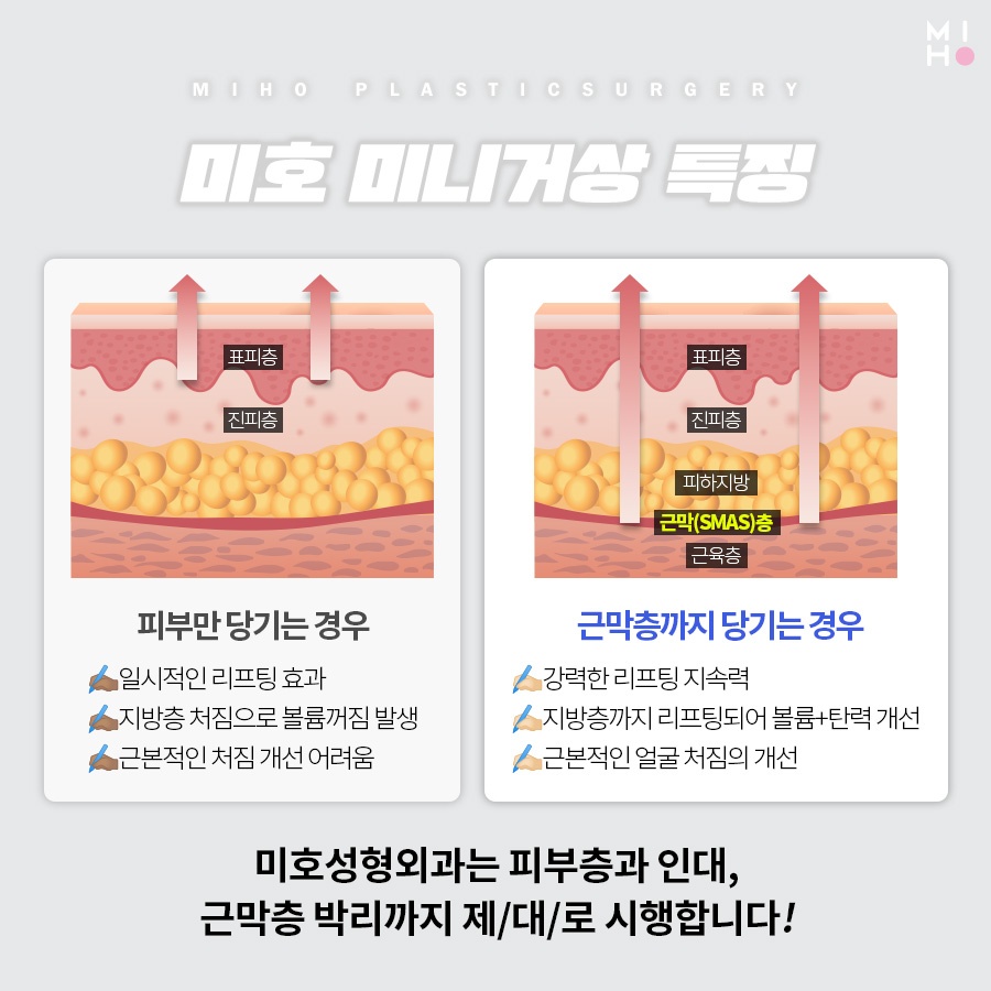 미니거상 처짐이 걱정이라면 관련 이미지 3