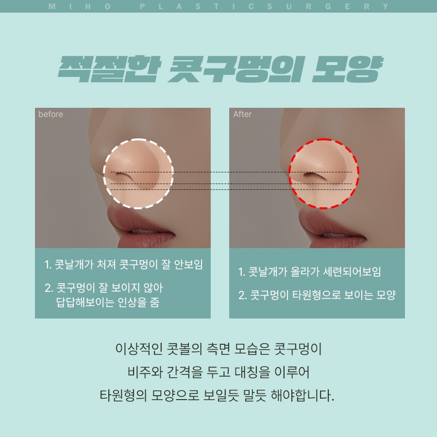 Creating a Naturally Refined Nose with an Alar Lift image 4