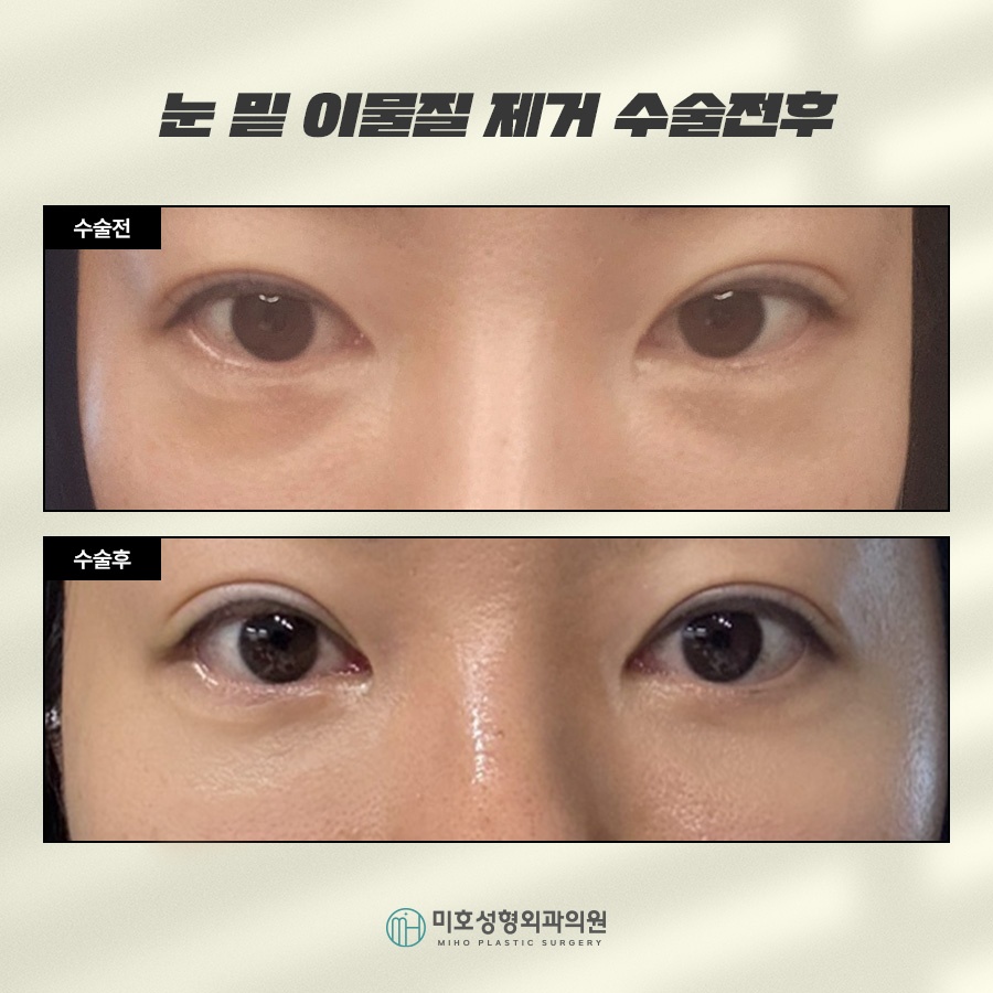 Under-Eye Fat Grafting and Filler Lumps: Addressing Side Effects Through Under-Eye Fat Repositioning and Foreign-Material Removal image 7