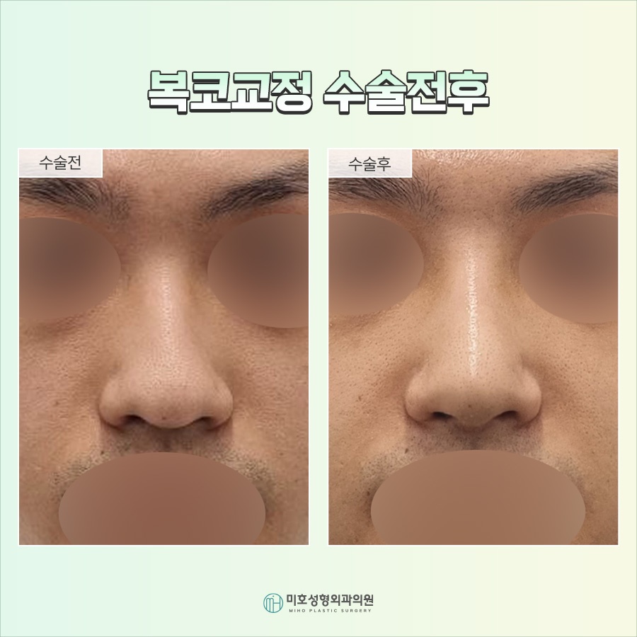 Nose Tip Refinement for a More Defined Impression image 9