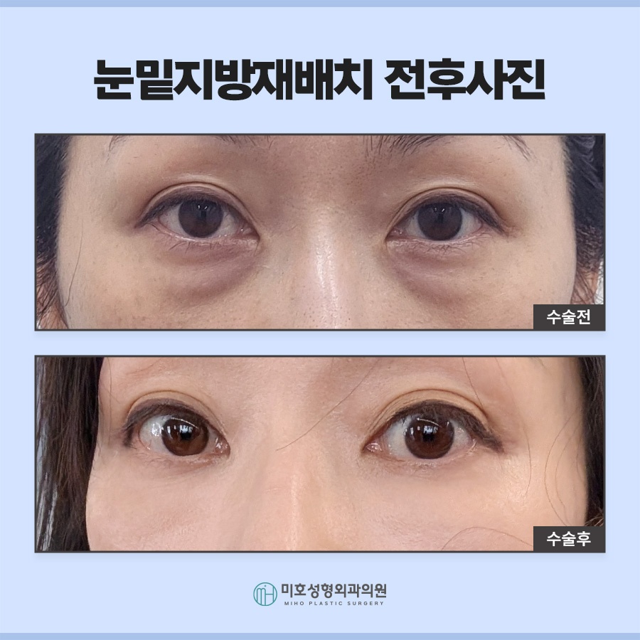 눈밑지 다크서클 처짐 고민된다면 관련 이미지 8