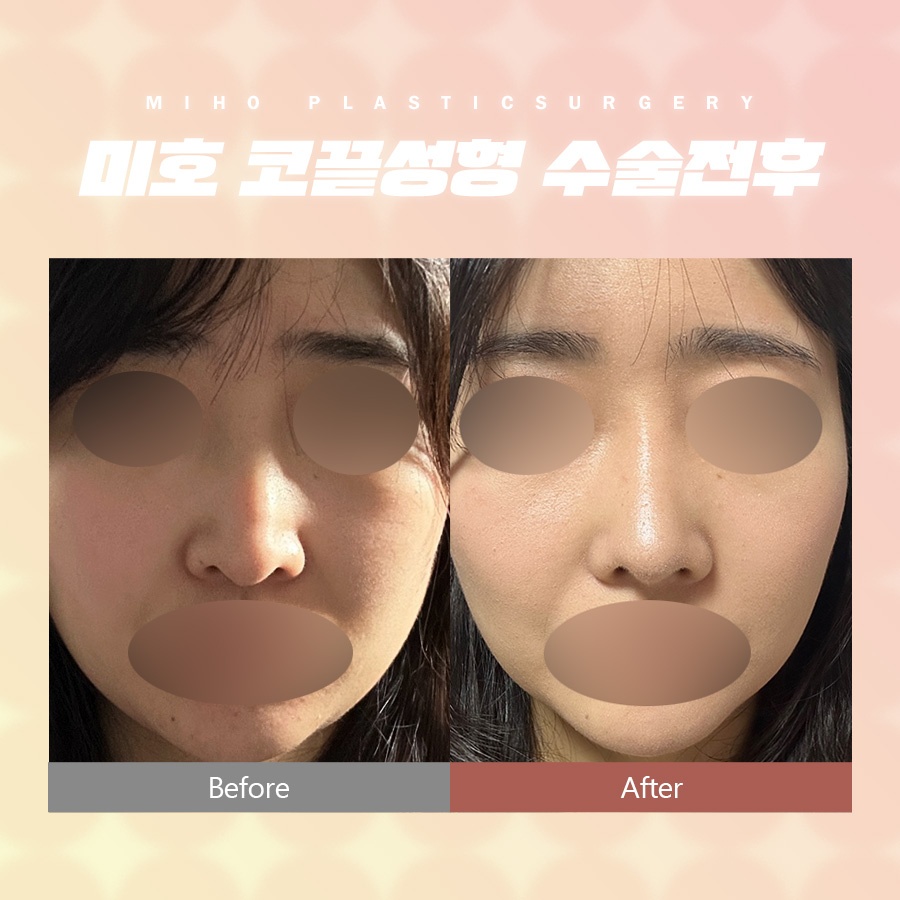 코끝성형 약간의 보완만으로 관련 이미지 7