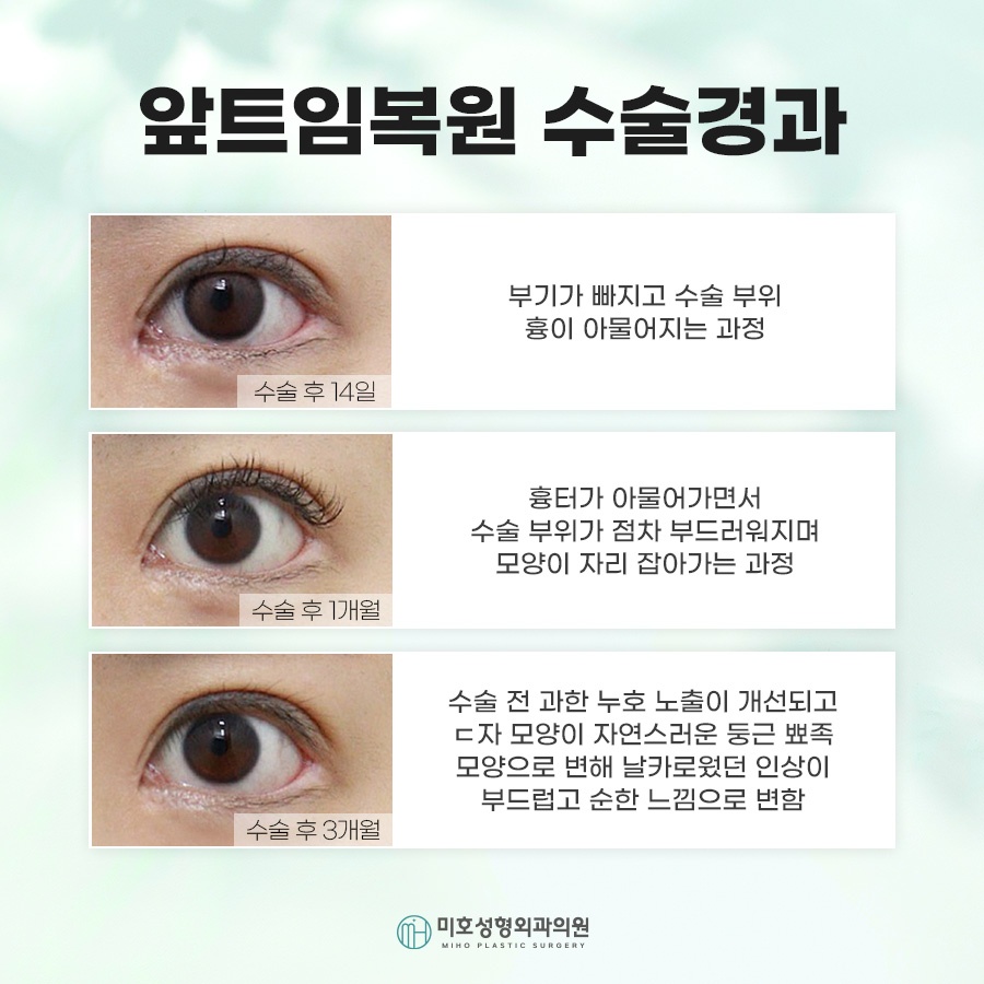 How Medial Canthoplasty Restoration Is Performed and Scar Care image 6
