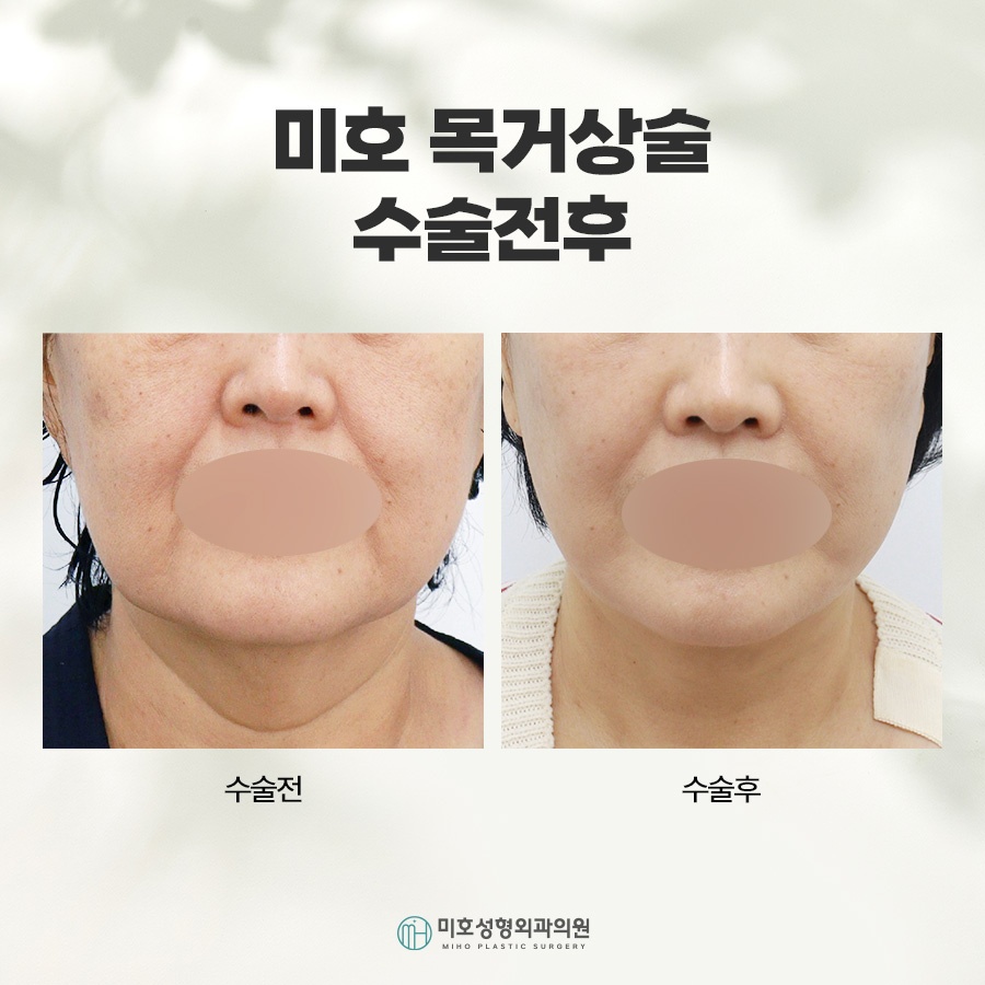 Neck Lift: A Lifting Method to Restore a Sagging Neckline image 8