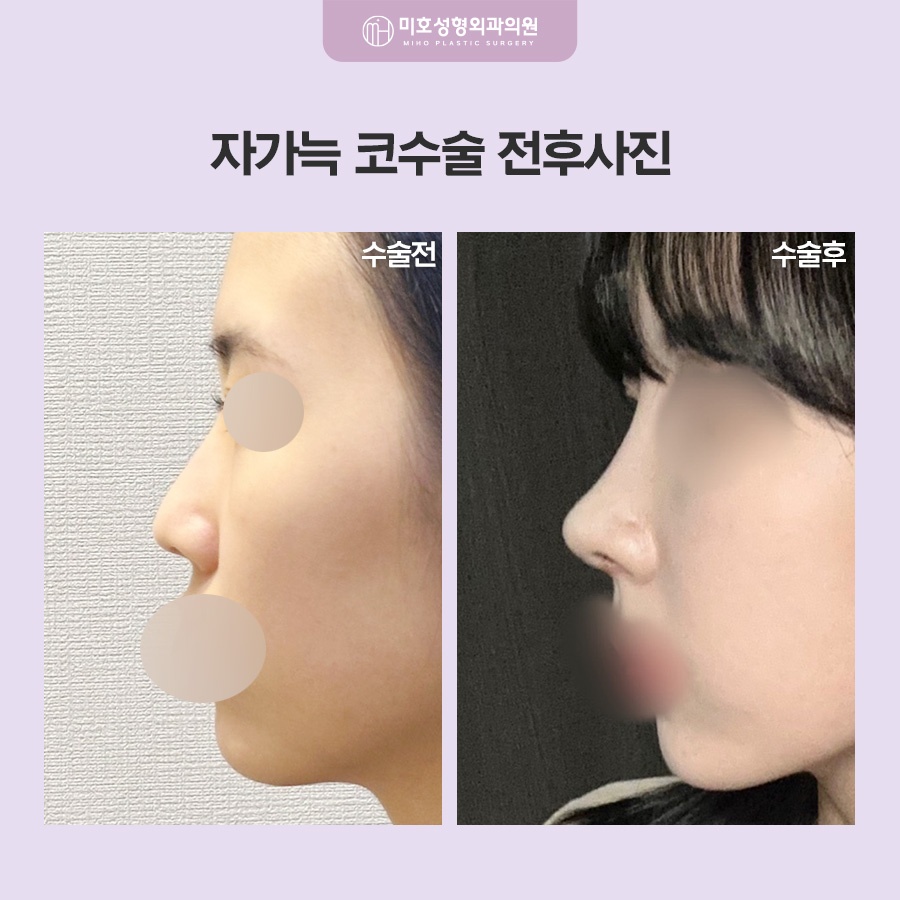 자가늑코수술 흉터와 통증이 걱정된다면 관련 이미지 9