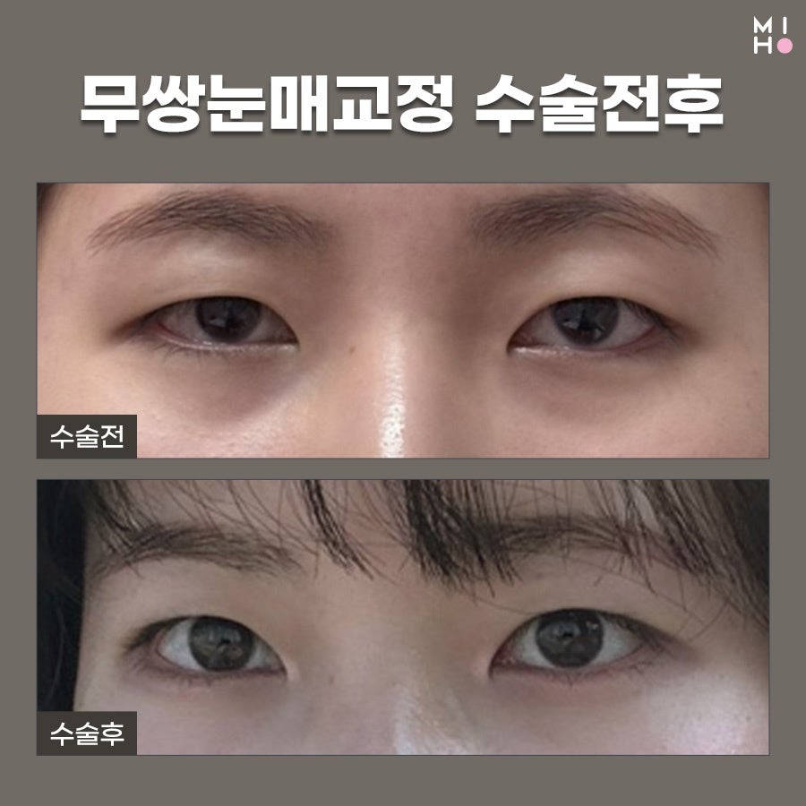 무쌍눈매교정 상황에 따른 개선법 관련 이미지 19
