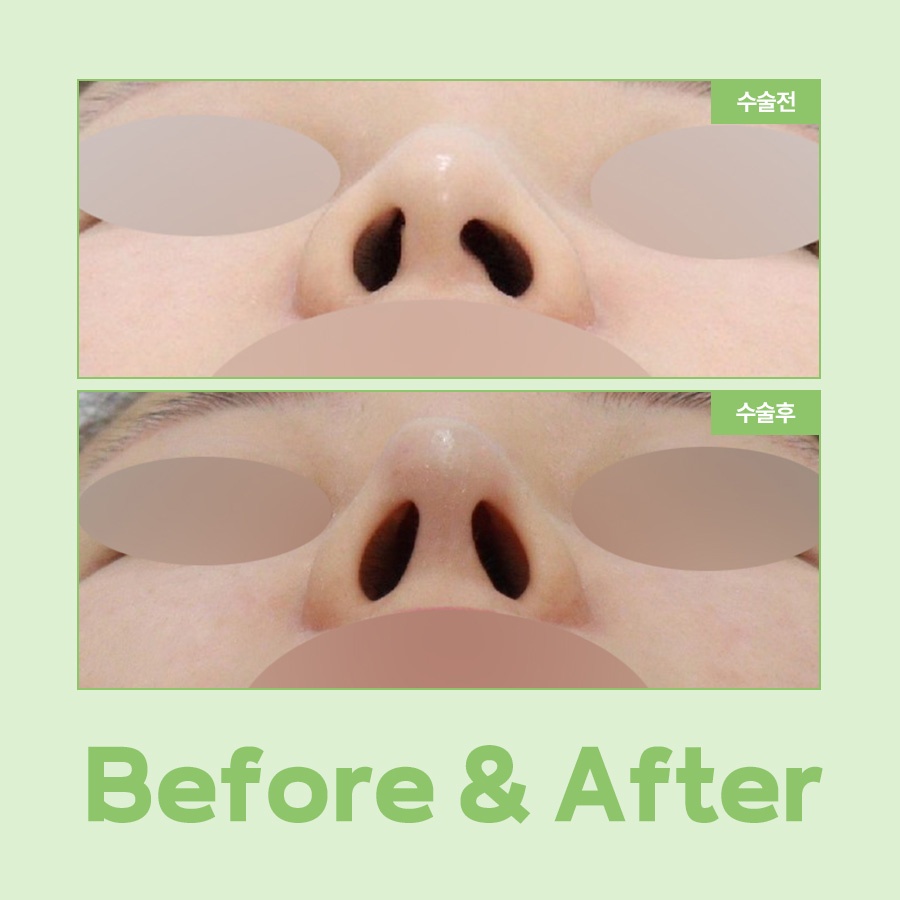 A Complete Guide to the Causes of Uneven Nostrils and the Timing of Revision Rhinoplasty image 6