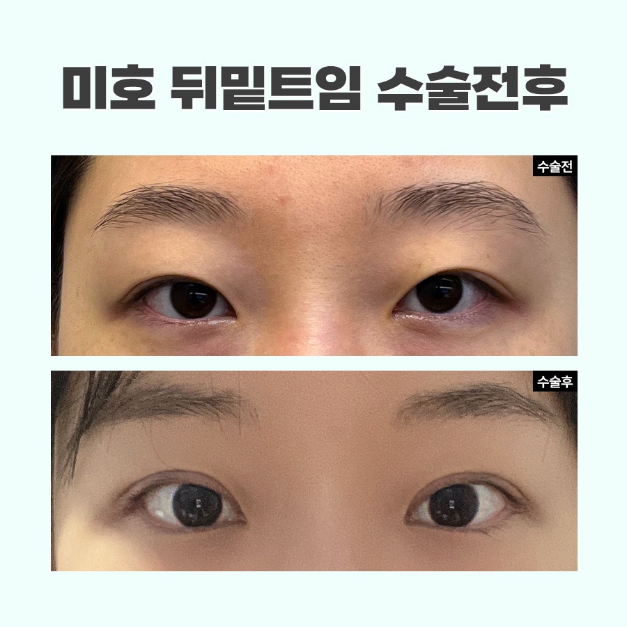 뒷트임밑트임후기 주의할 점 관련 이미지 7