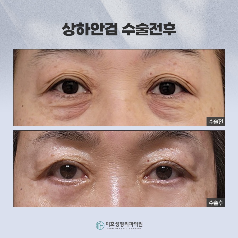 An In-Depth Analysis of Upper and Lower Blepharoplasty image 10
