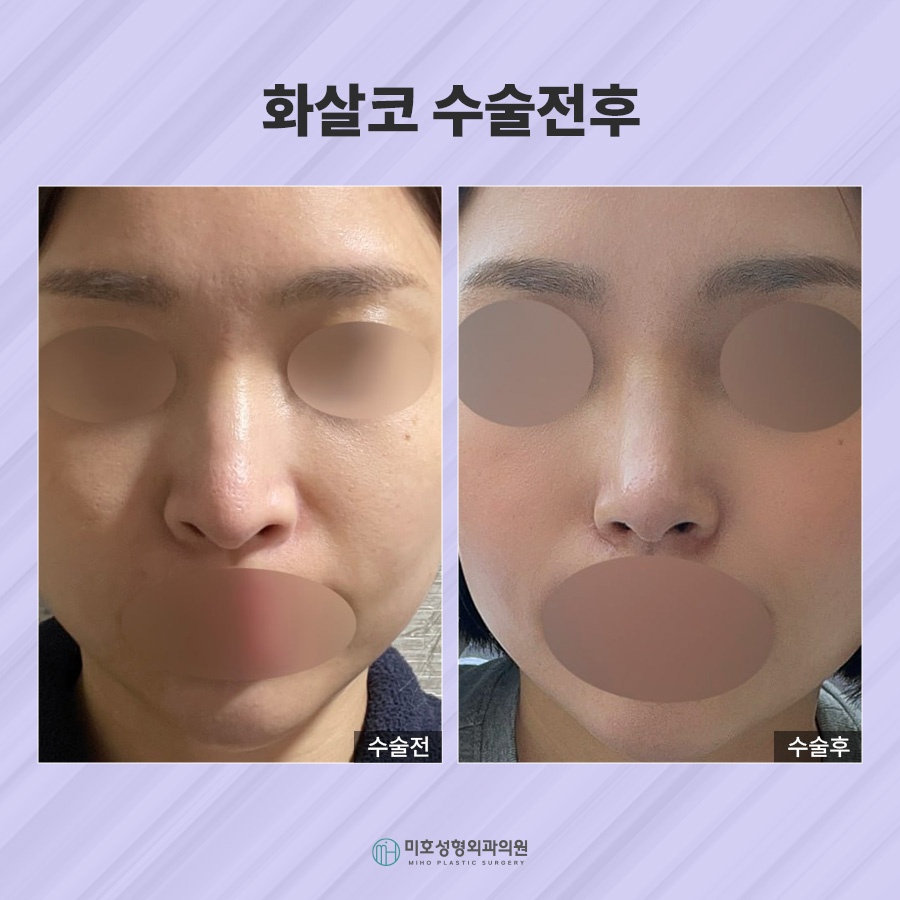 화살코 교정 방법 및 관리수칙 관련 이미지 9