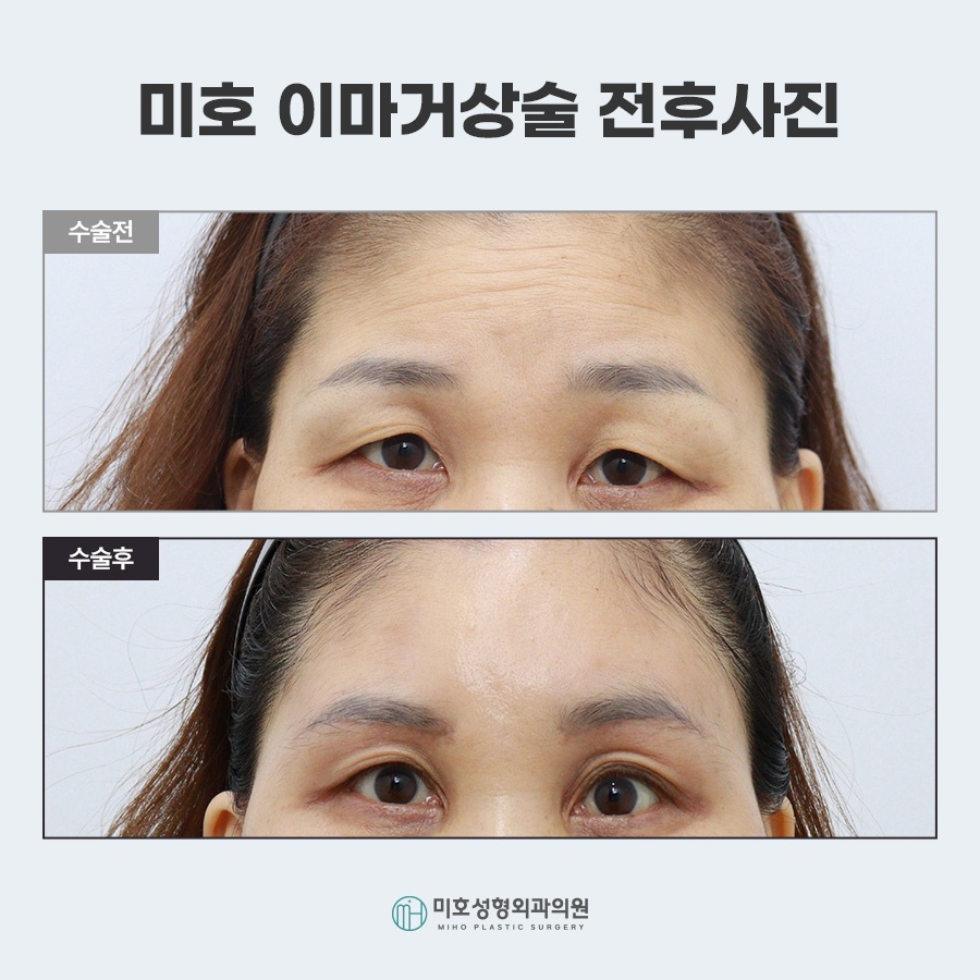 이마거상비용 방법 비교 관련 이미지 8