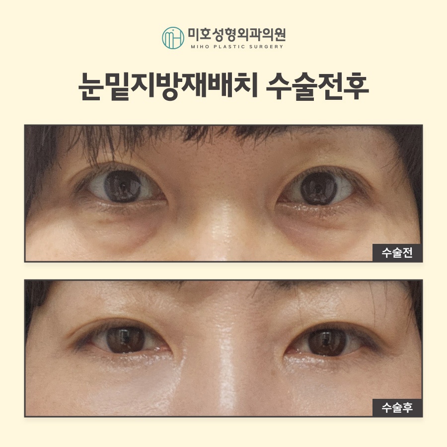 눈밑지방재배치 빠른 대처 방안 관련 이미지 10