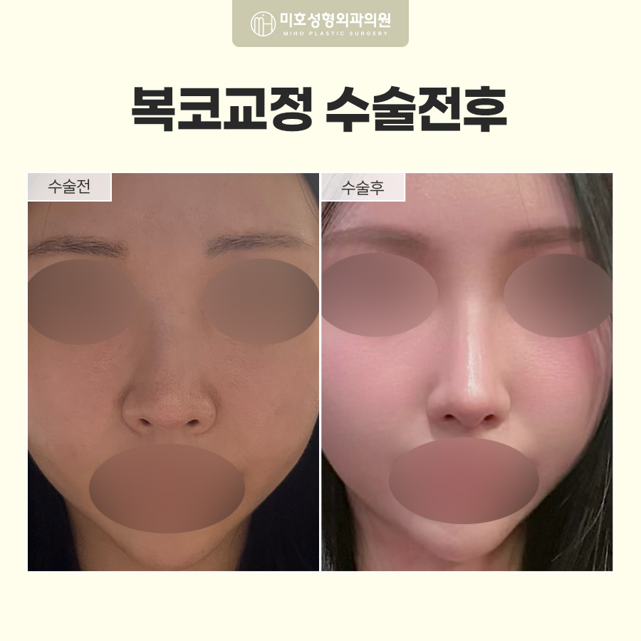 복코교정이란? 복코 원인부터 수술방법, 회복기간까지 알아보기 관련 이미지 7