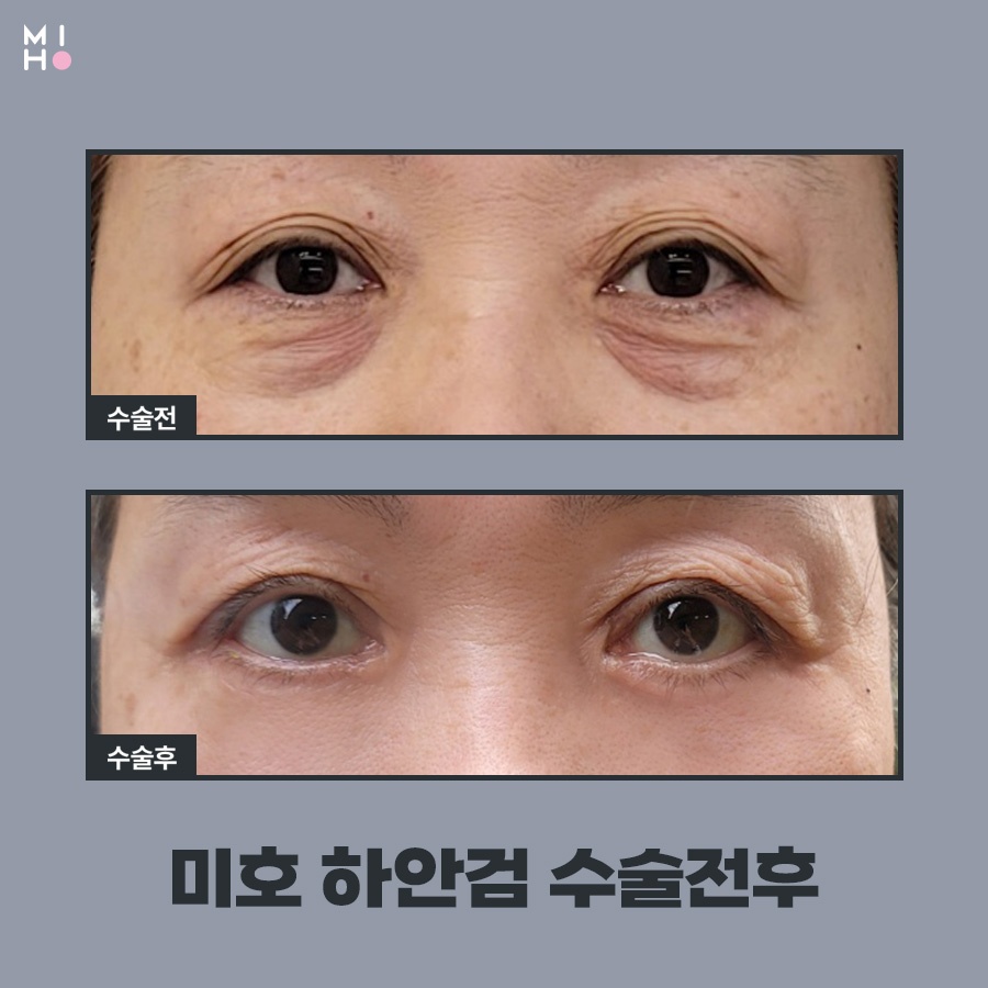 하안검수술 이미지 변신도 안전하게 관련 이미지 5