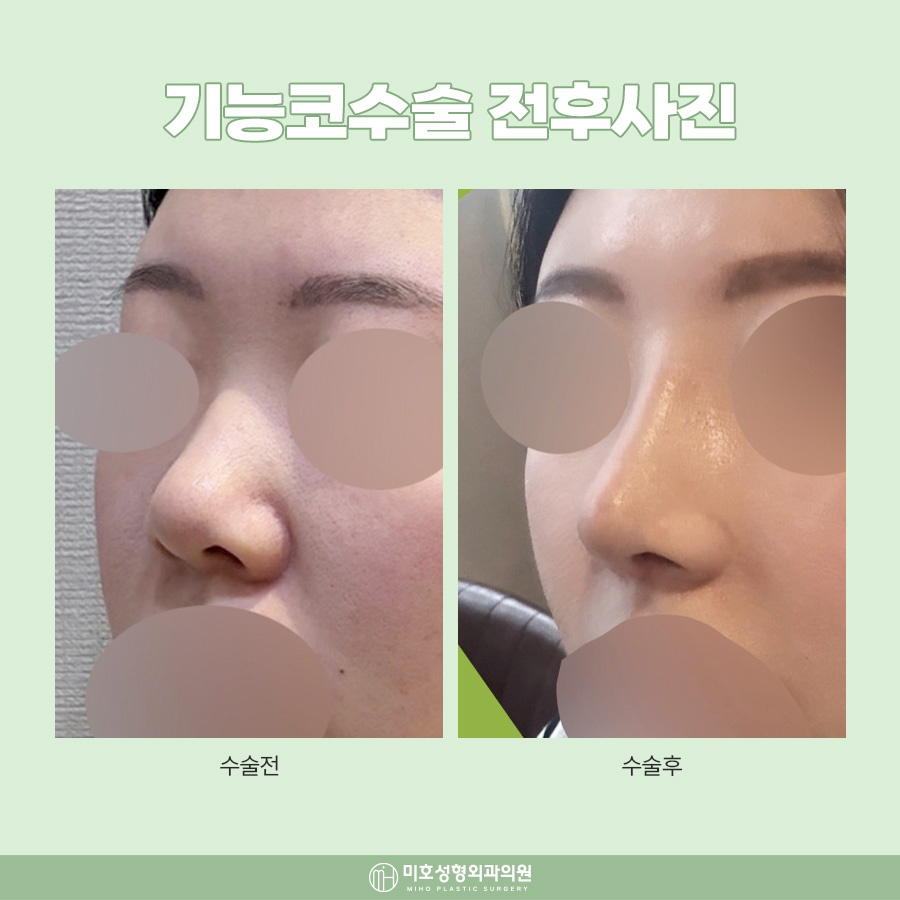 하비갑개절제술 코막힘 개선 방법 관련 이미지 10