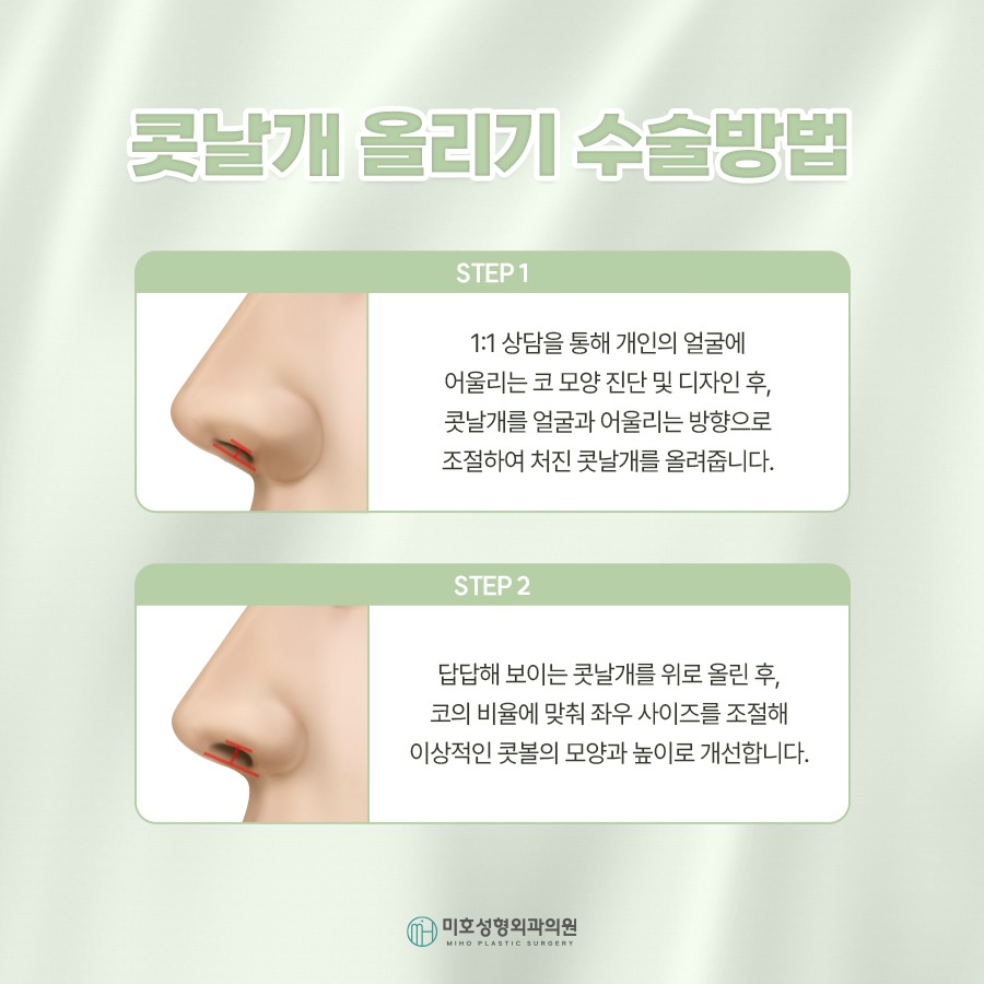 콧날개올리기 처진 코 교정 관련 이미지 5
