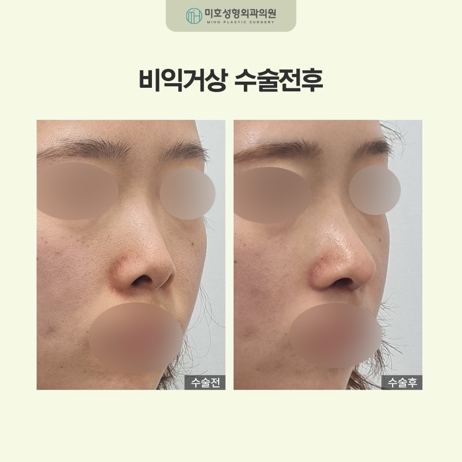 비익거상으로 예쁜 코 만드는 비결 총정리 관련 이미지 6