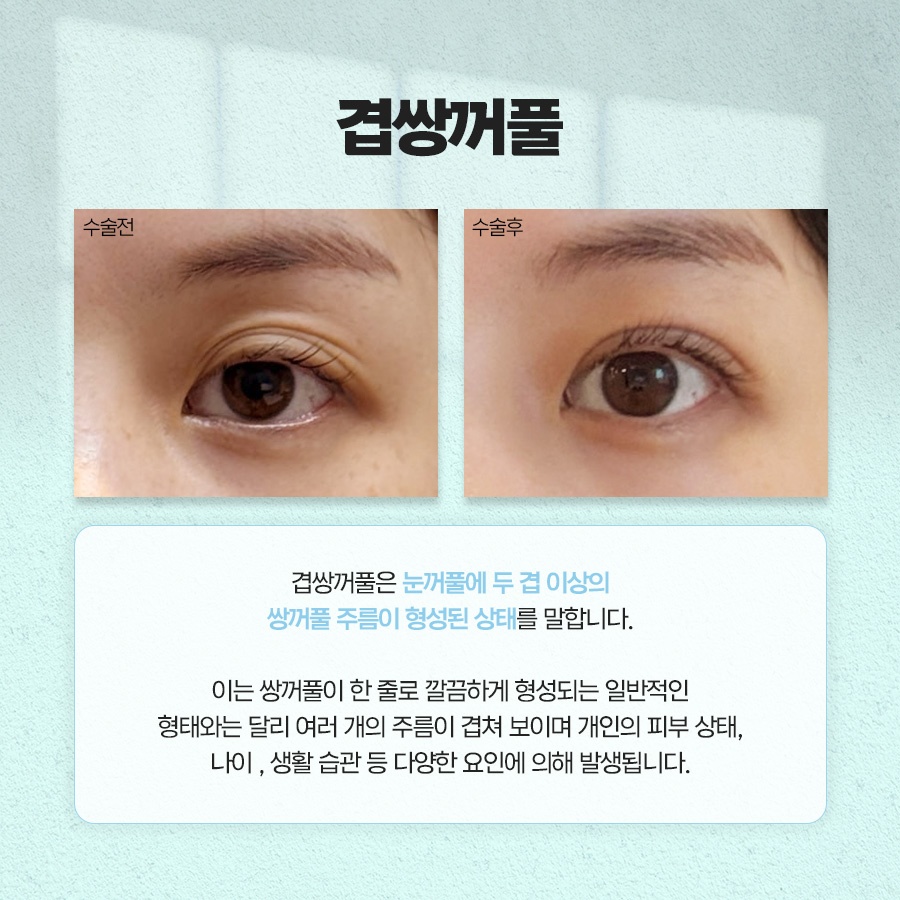 겹쌍꺼풀 생기는 이유와 없애는 방법까지 관련 이미지 2