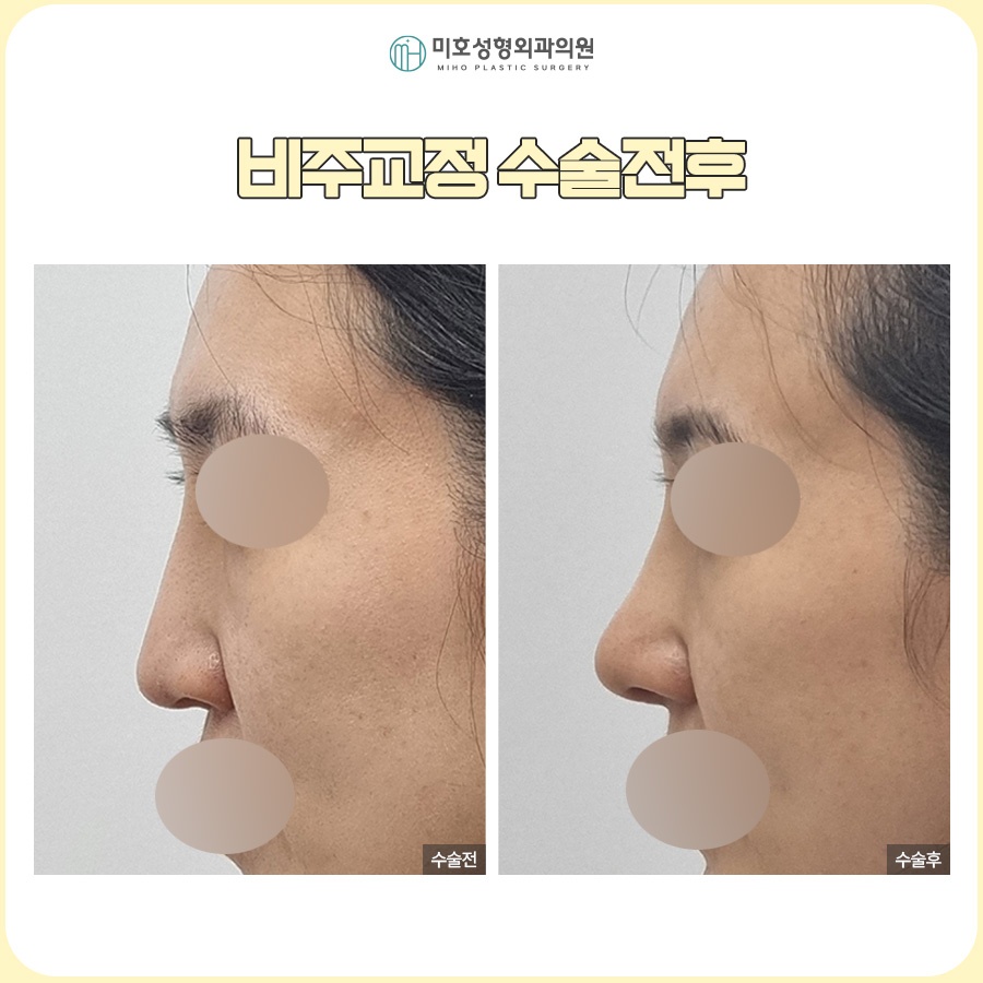 비주내리기 입체적이고 세련된 옆라인을 만드는 방법 관련 이미지 9