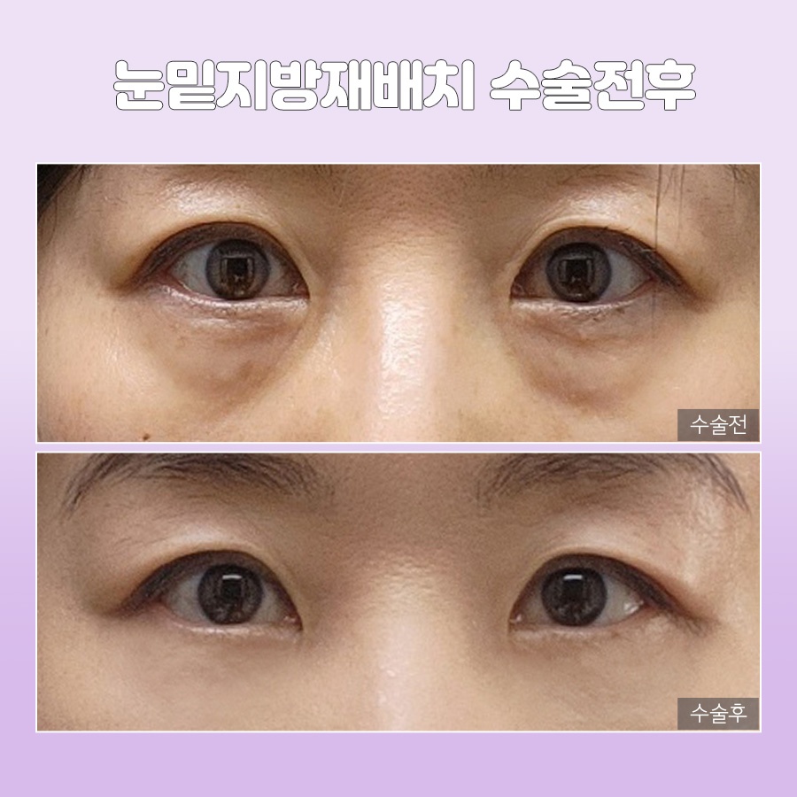 미호 시그니처 눈밑성형 지방재배치 눈매 개선 관련 이미지 7