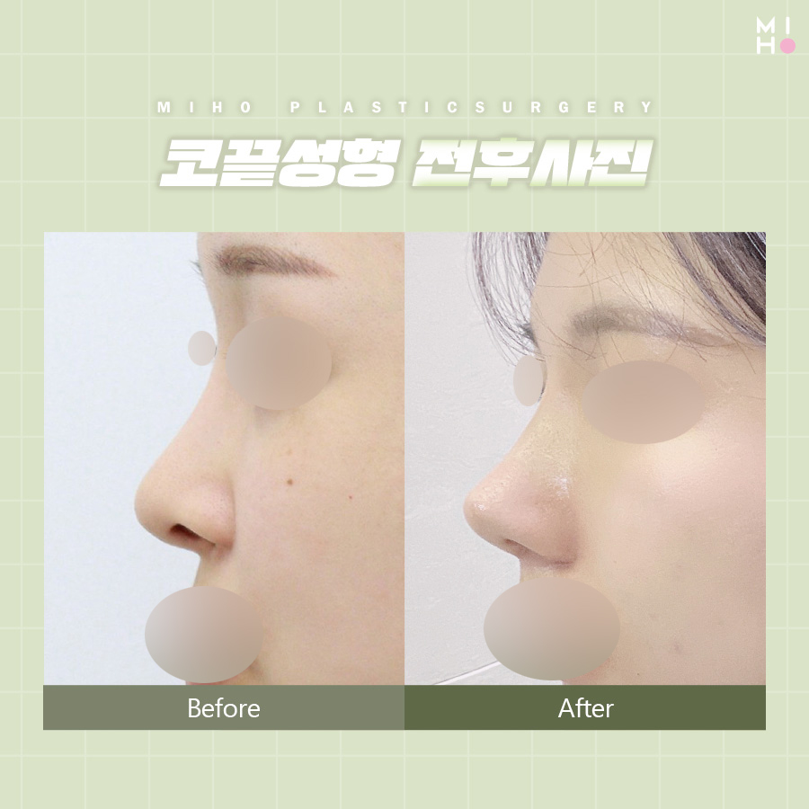 코끝성형 오똑하고 자연스럽게 관련 이미지 8
